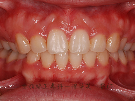 雙顎暴牙、下顎後縮、牙齒擁擠案例