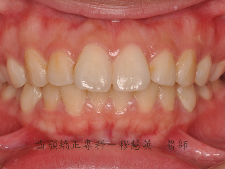 雙顎暴牙、下顎後縮、牙齒擁擠案例