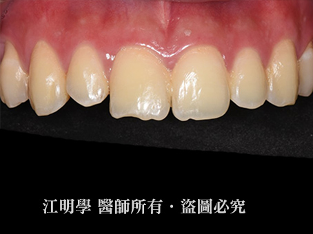 前牙美學＿瓷牙貼片