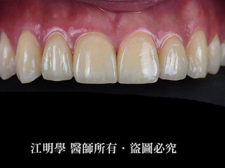 前牙美學＿瓷牙貼片