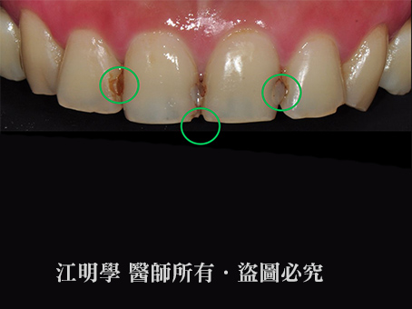 前牙美學＿補牙處染色