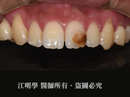 前牙美學＿氟斑齒