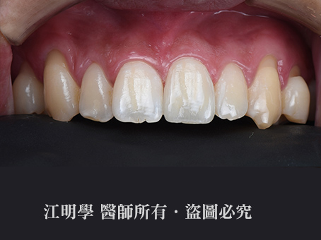 前牙美學＿氟斑齒