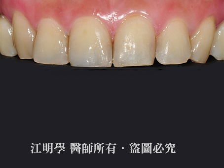前牙美學＿補牙處染色