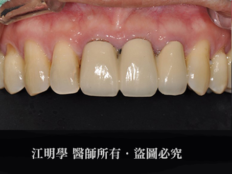 前牙美學＿更換金屬牙冠