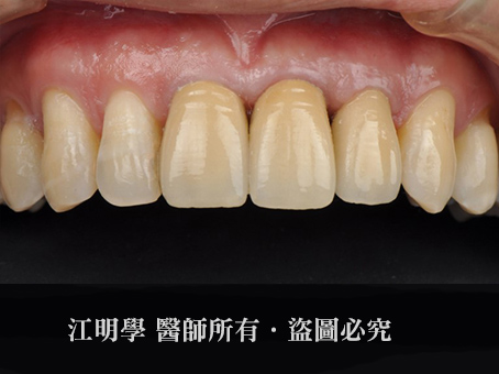 前牙美學＿更換金屬牙冠