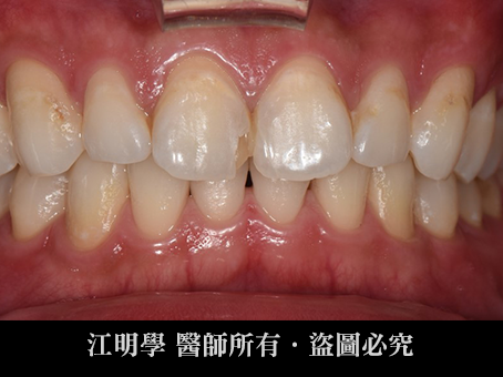 前牙美學＿全鋯冠