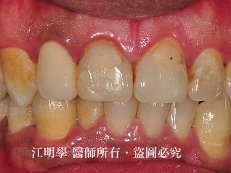 前牙美學＿美白貼片案例