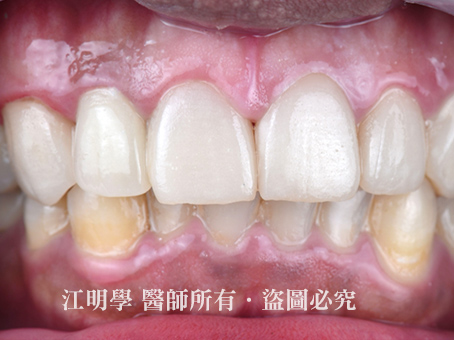 前牙美學＿美白貼片案例