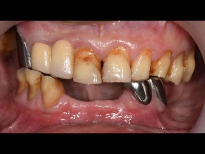 全口重建-All on 4