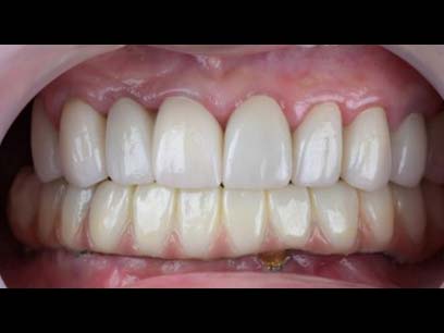 全口重建-All on 4