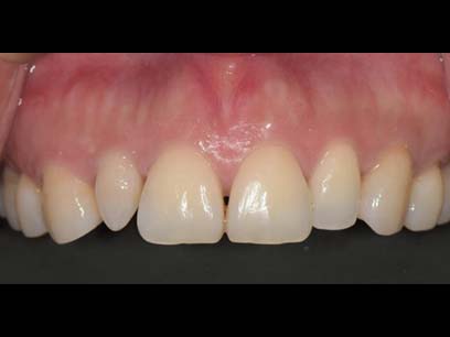 陶瓷貼片 畸形門牙