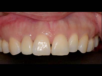 陶瓷貼片 畸形門牙