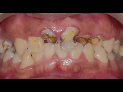 假牙+牙周合作全口重建