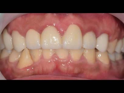 假牙+牙周合作全口重建
