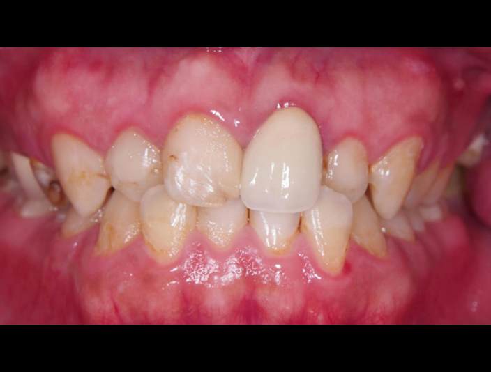 牙周治療->矯正->貼片