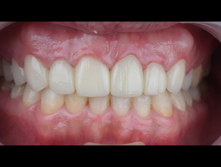 牙周治療->矯正->貼片