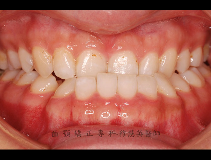 齒顎矯正配合正顎手術改善戽斗的臉型及咬合