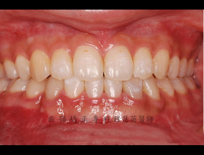 齒顎矯正配合正顎手術改善戽斗的臉型及咬合