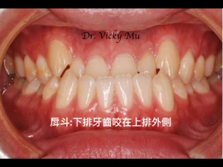 戽斗(地包天)案例的治療