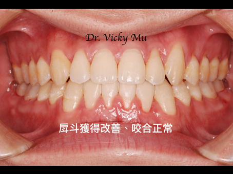 戽斗(地包天)案例的治療