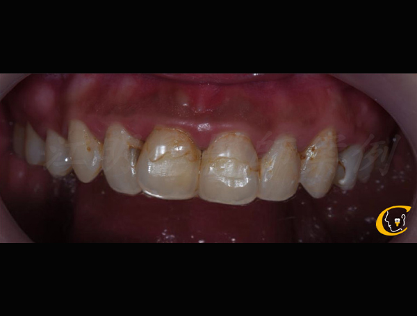 美白貼片治療效果