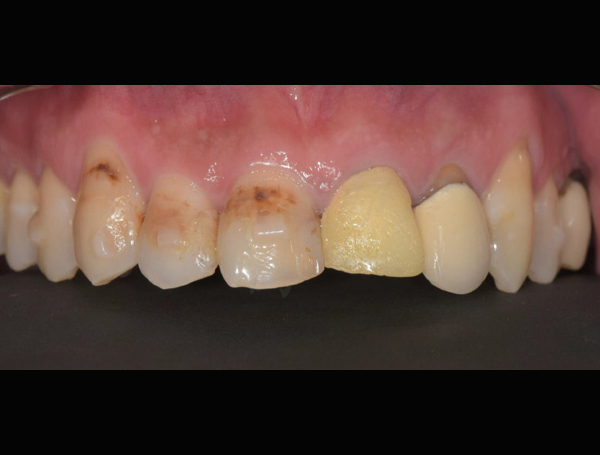 美白貼片治療效果