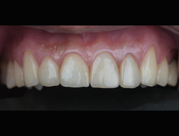 美白貼片治療效果