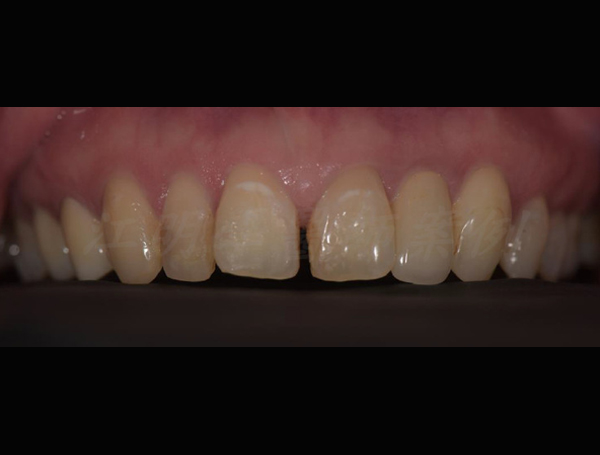 美白貼片治療效果