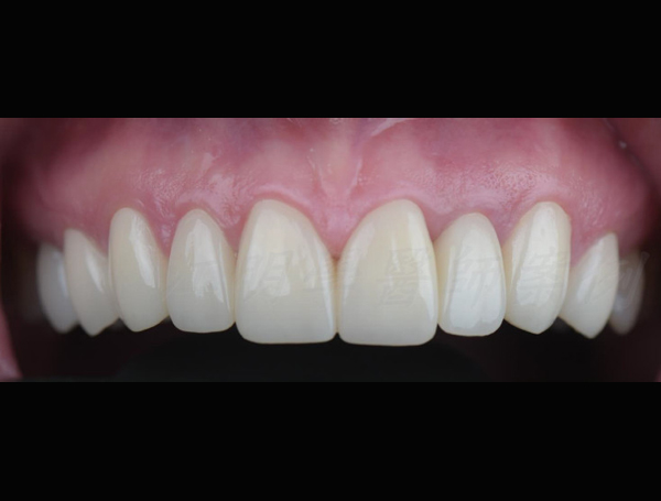 美白貼片治療效果