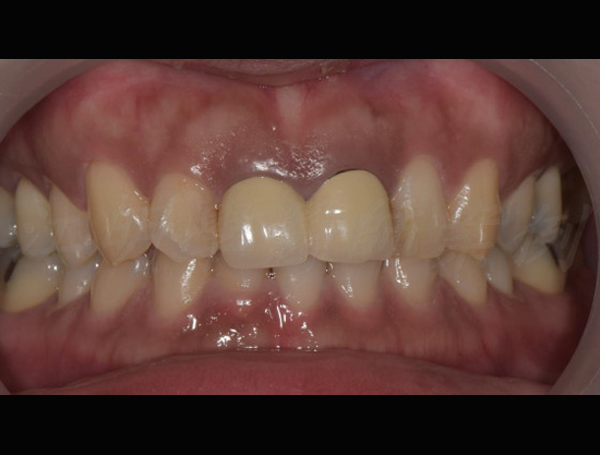 美白貼片治療效果