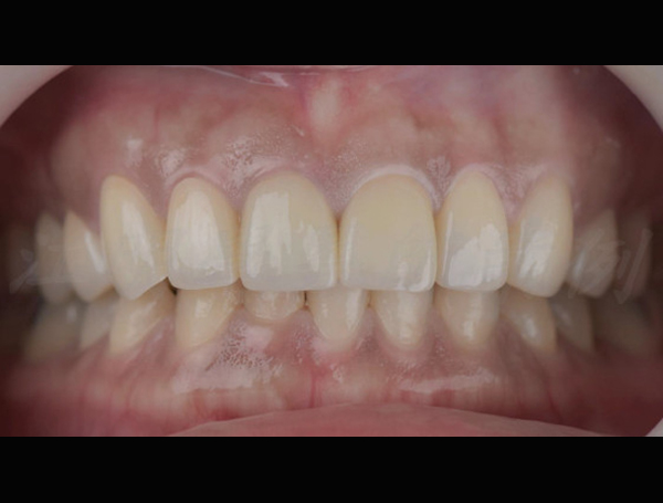 美白貼片治療效果