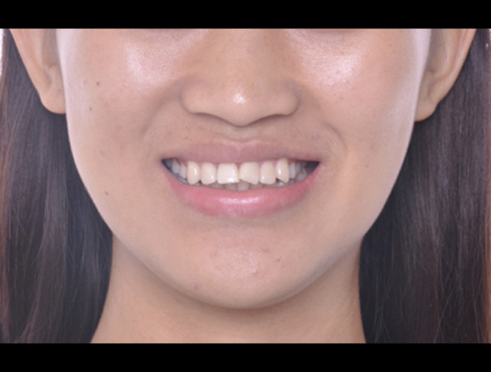 智齒取代大臼齒案例-隱適美