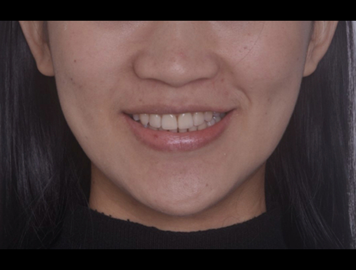 智齒取代大臼齒案例-隱適美