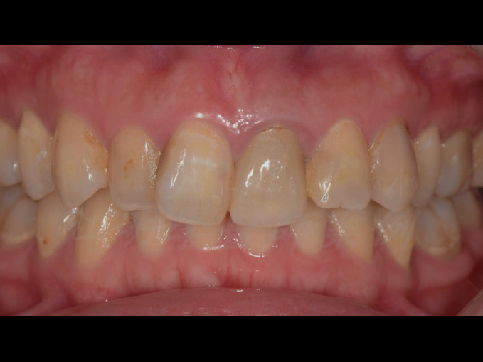 美白貼片治療效果