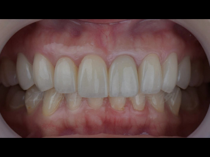 美白貼片治療效果