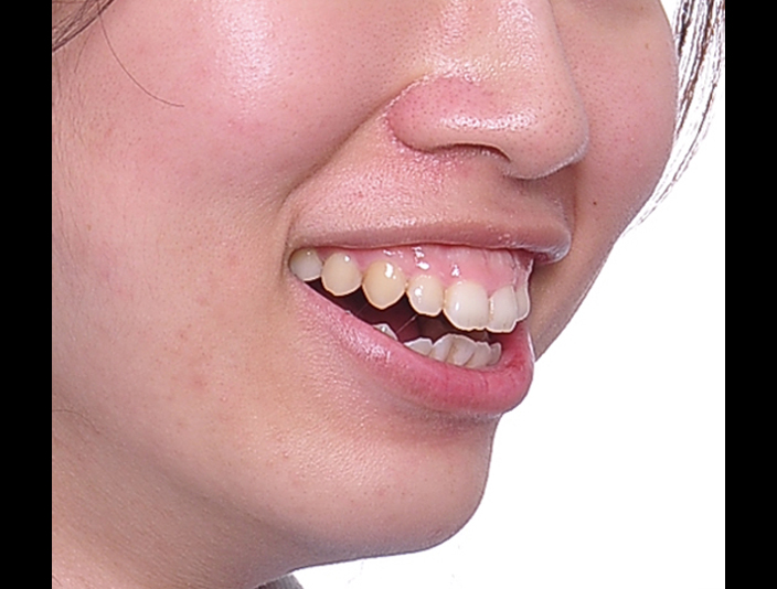 暴牙、笑齦、拔牙