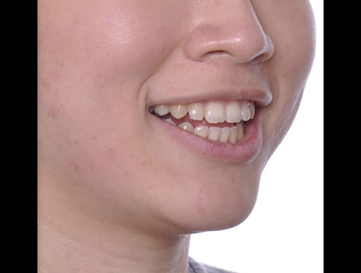 暴牙、笑齦、拔牙