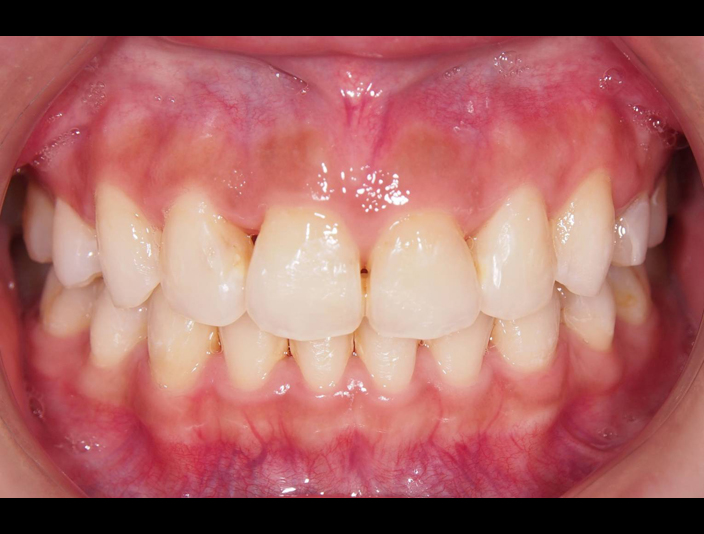 適當的牙齦露出量是擁有美麗迷人笑容的關鍵因素之一