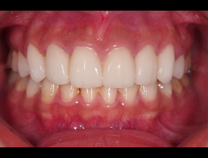 適當的牙齦露出量是擁有美麗迷人笑容的關鍵因素之一