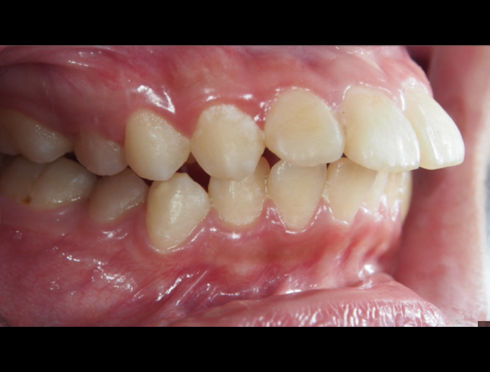 拔牙矯正的暴牙案例-隱適美