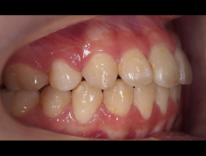 拔牙矯正的暴牙案例-隱適美