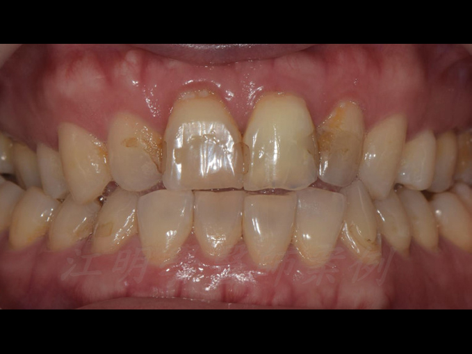 美白貼片治療效果