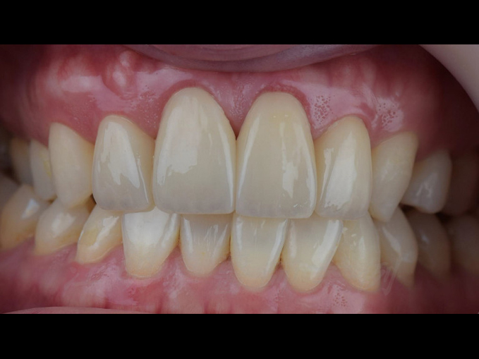 美白貼片治療效果