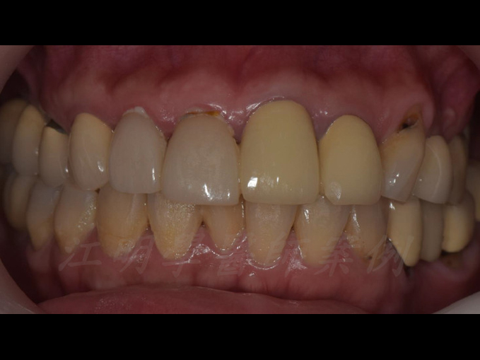 美白貼片治療效果