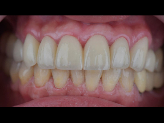 美白貼片治療效果