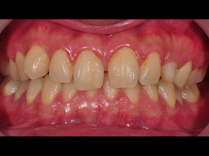 美白貼片治療效果