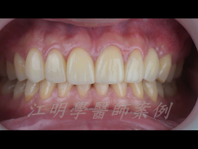 美白貼片治療效果