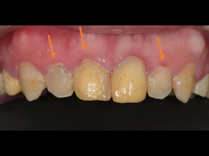 矯正+假牙+貼片+牙周合作全口重建