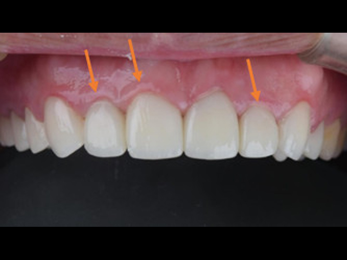 矯正+假牙+貼片+牙周合作全口重建